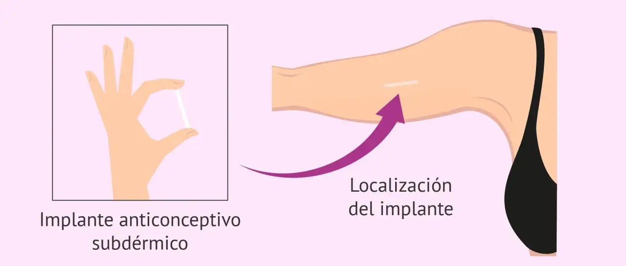 Mano sostiene implante anticonceptivo subdérmico. Flecha indica localización del implante en el brazo.