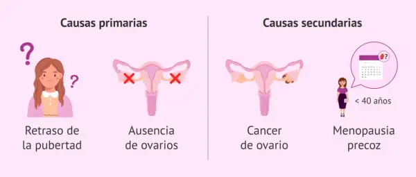 Ilustración explica que se puede tener la regla sin sangrar, mostrando causas primarias (retraso pubertad, ausencia ovarios) y secundarias (cáncer ovario, menopausia precoz).