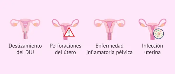 Ilustración de útero con DIU, deslizamiento, perforación, enfermedad inflamatoria pélvica e infección uterina. Reposo tras colocar el DIU Mirena.