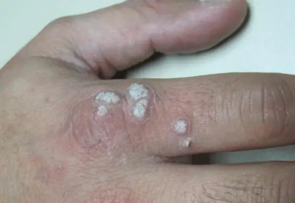 Verrugas en la mano, con aspecto escamoso y blanquecino. La diferencia entre verruga y condiloma es importante para el diagnóstico.